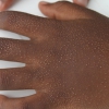 Mollusco contagioso sulle mani di un bimbo